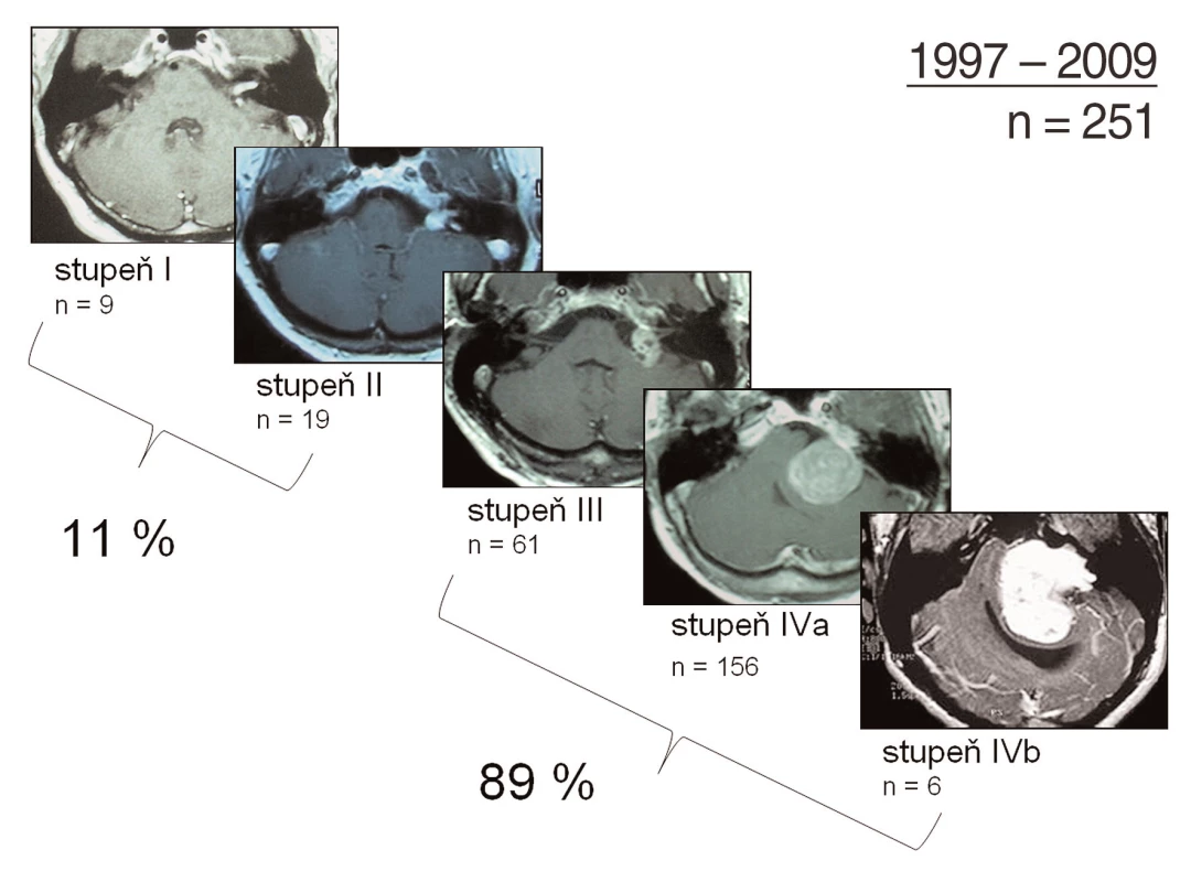 Klasifikace velikosti vestibulárních schwannomů: přehled operovaných vestibulárních schwannomů na Klinice otorinolaryngologie a chirurgie hlavy a krku 1. LF UK a FN v Motole v letech 1997–2008