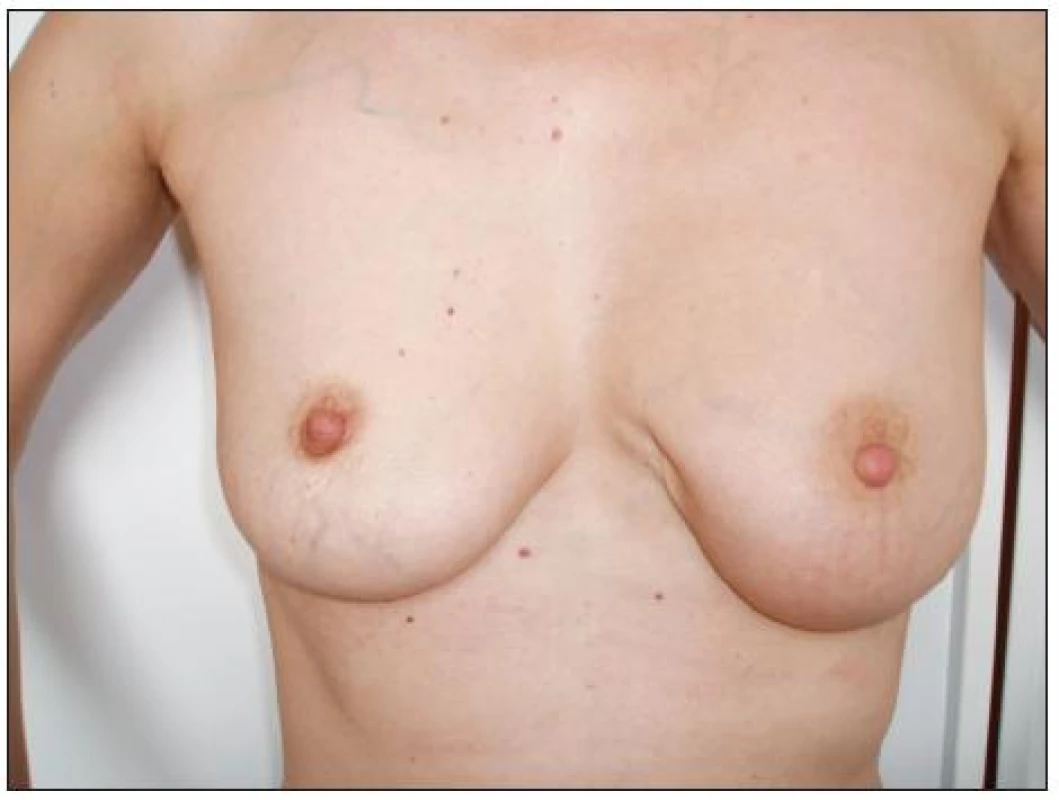 Stav po parciální resekci levého prsu
Fig. 1. The patient’s condition following her left breast resection