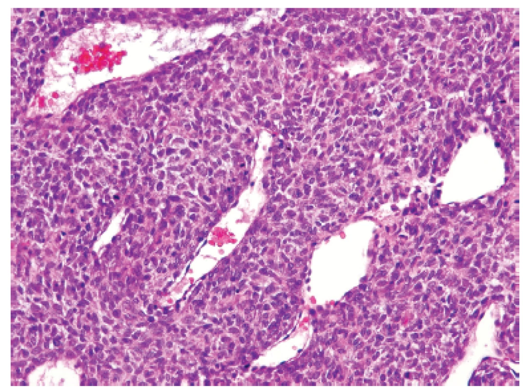 Kazuistika &lt;b&gt;2&lt;/b&gt;. Blandně vyhlížející vřetenobuněčný sarkom s bohatou kapilární sítí připomínající nespecifickou &lt;i&gt;HPC-like&lt;/i&gt; úpravu např. synoviálního sarkomu či solitárního fibrózního tumoru (HE, 200x).