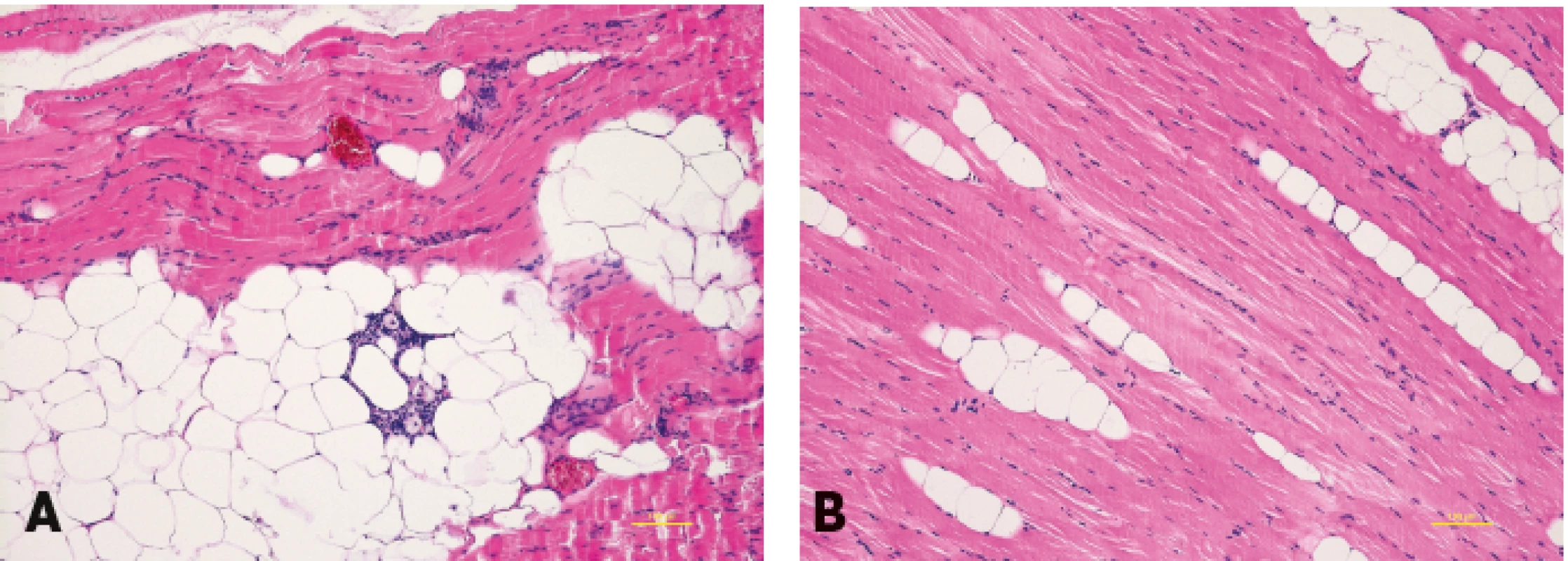 Histological examination of the muscles: (a) the pectoralis muscle after fat grafting with lipomatous changes, (b) the serratus anterior muscle - the control sample from the same patient (without fat grafting). Haematoxylin eosin staining. Scale bar 100 mm.