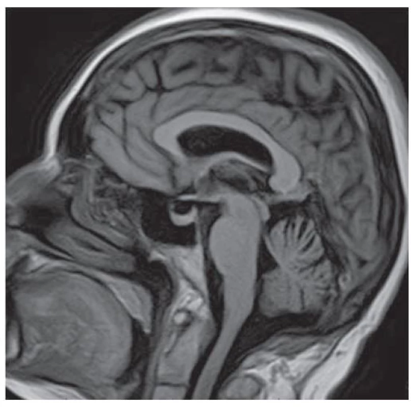 MRI mozku sagitalní řez; partial empty sella