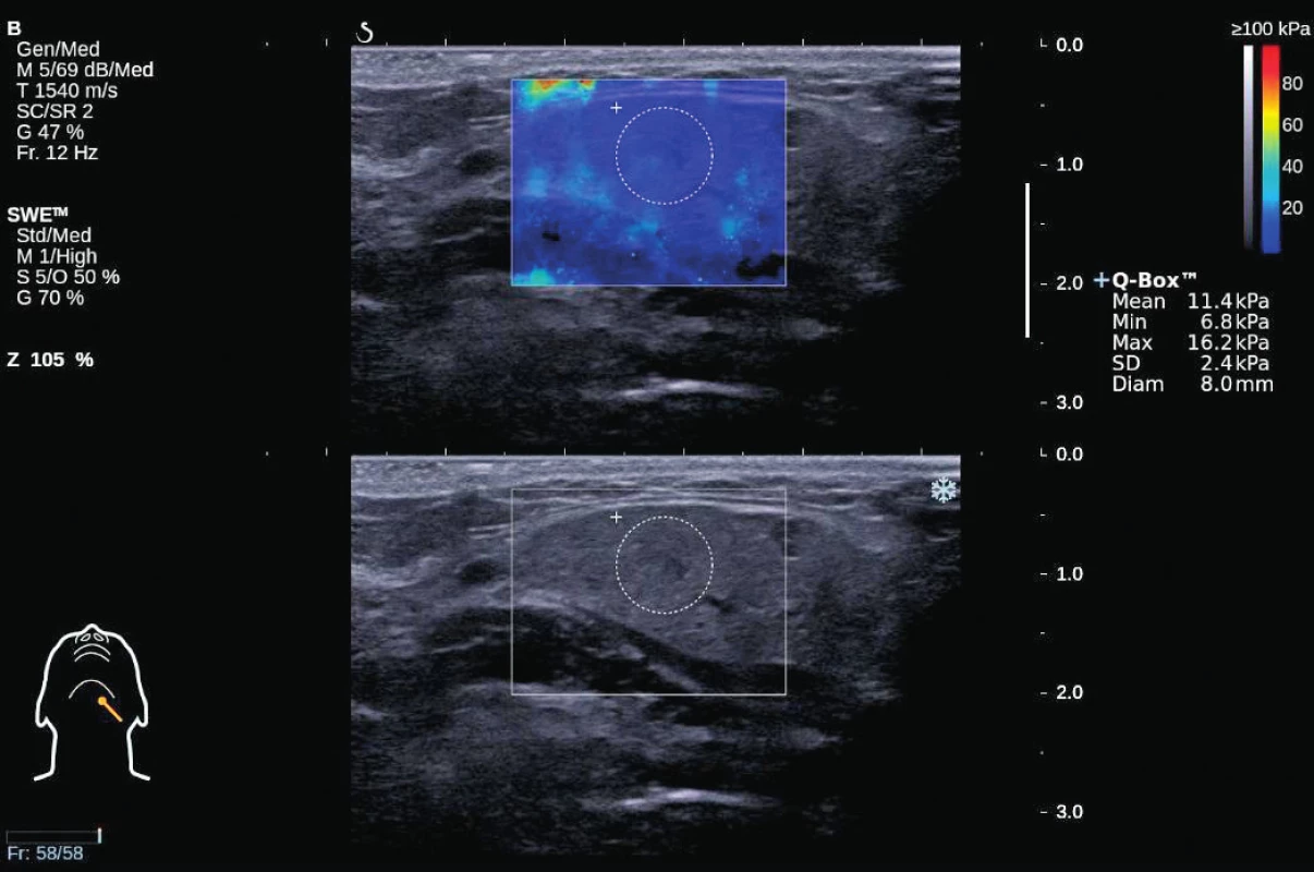 Shear wave elastografie – normální nález na levé submandibulární žláze u 51leté zdravé dobrovolnice; přiměřená střední elasticita 11,4 kPa