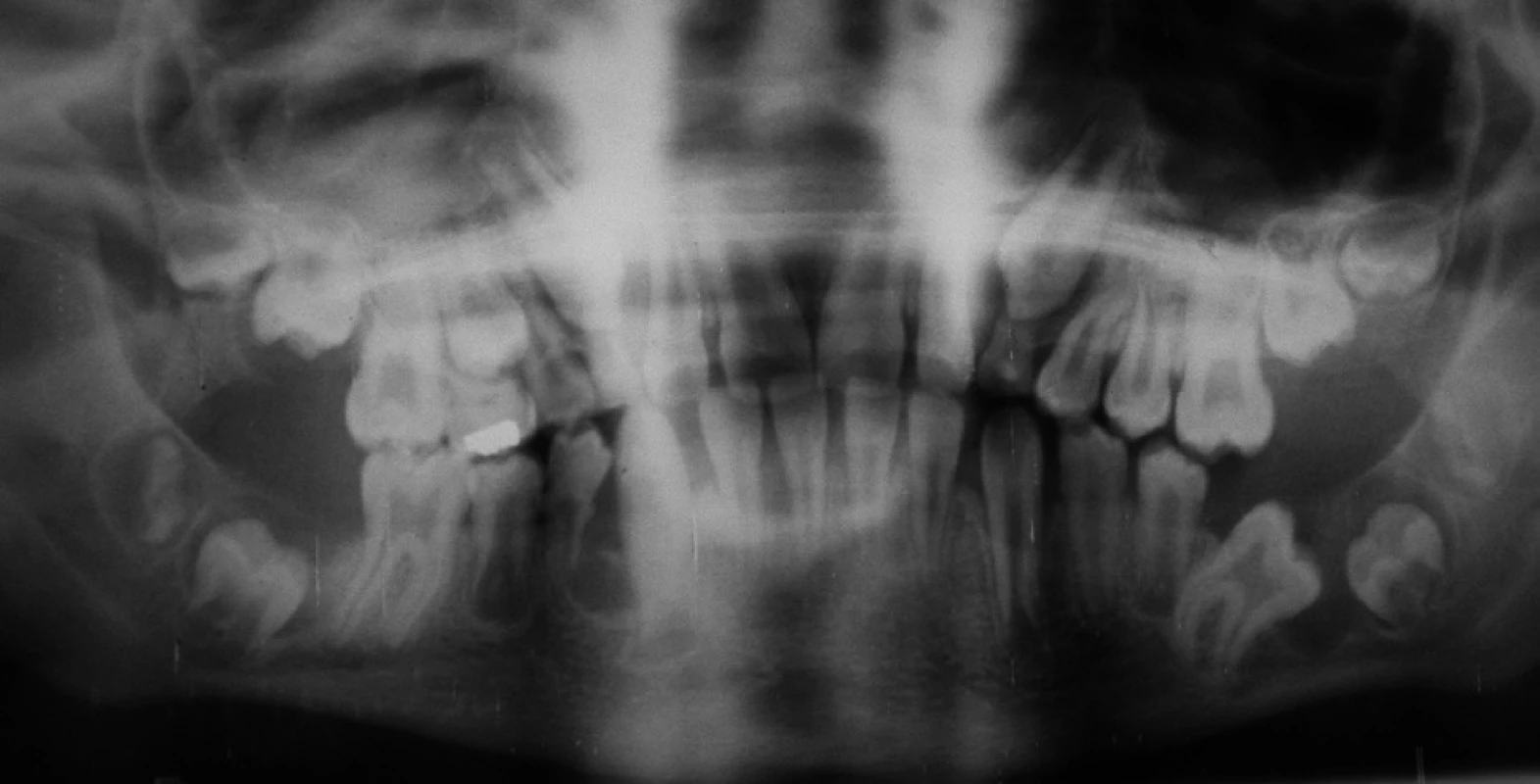 OPG snímek, retence zubu 36 s folikulární cystou