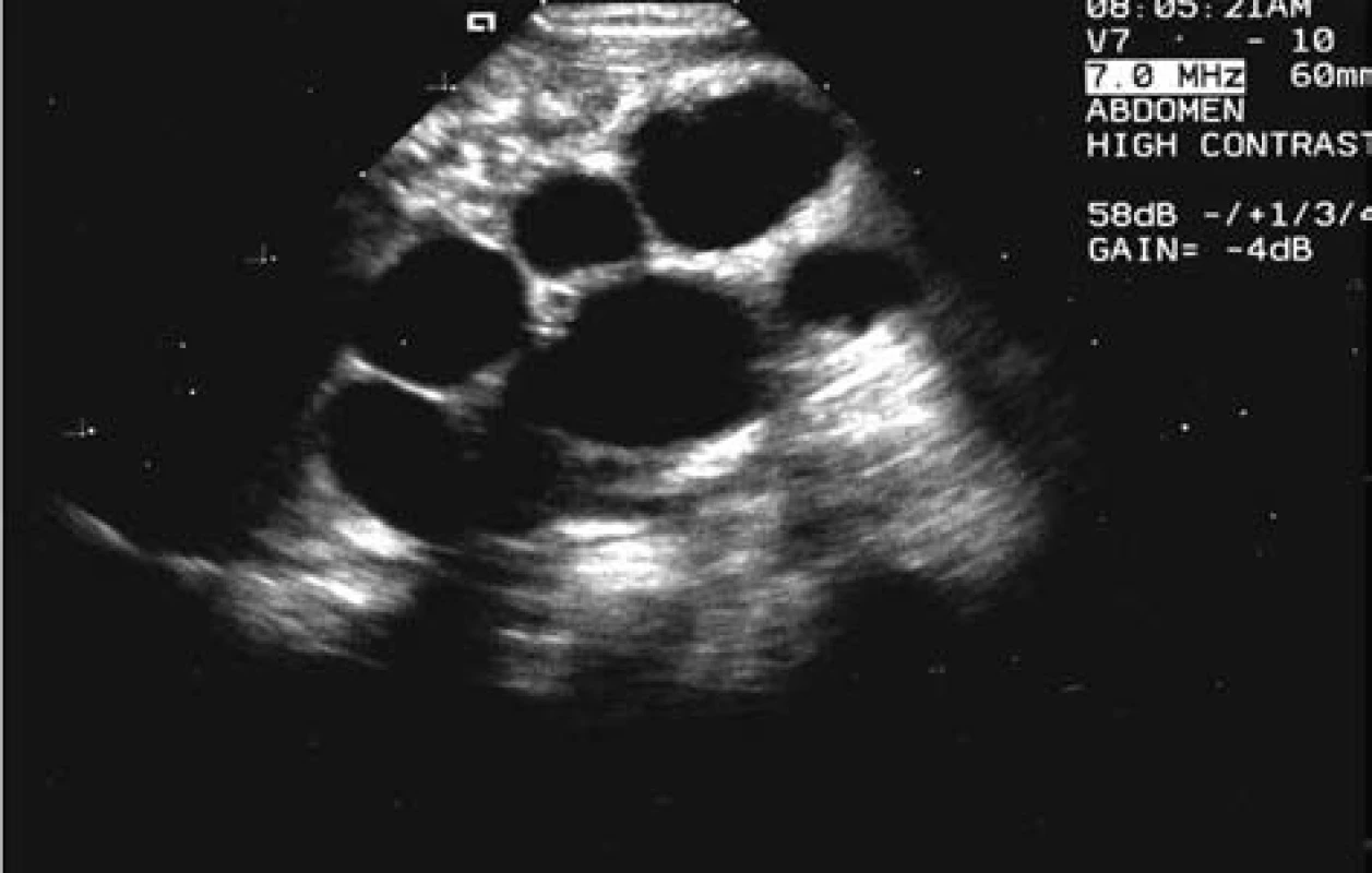 MCDK při stanovení diagnózy u chlapce v novorozeneckém věku.
Fig. 3.MCDK in the determination of diagnosis in a boy of a newborn age.
