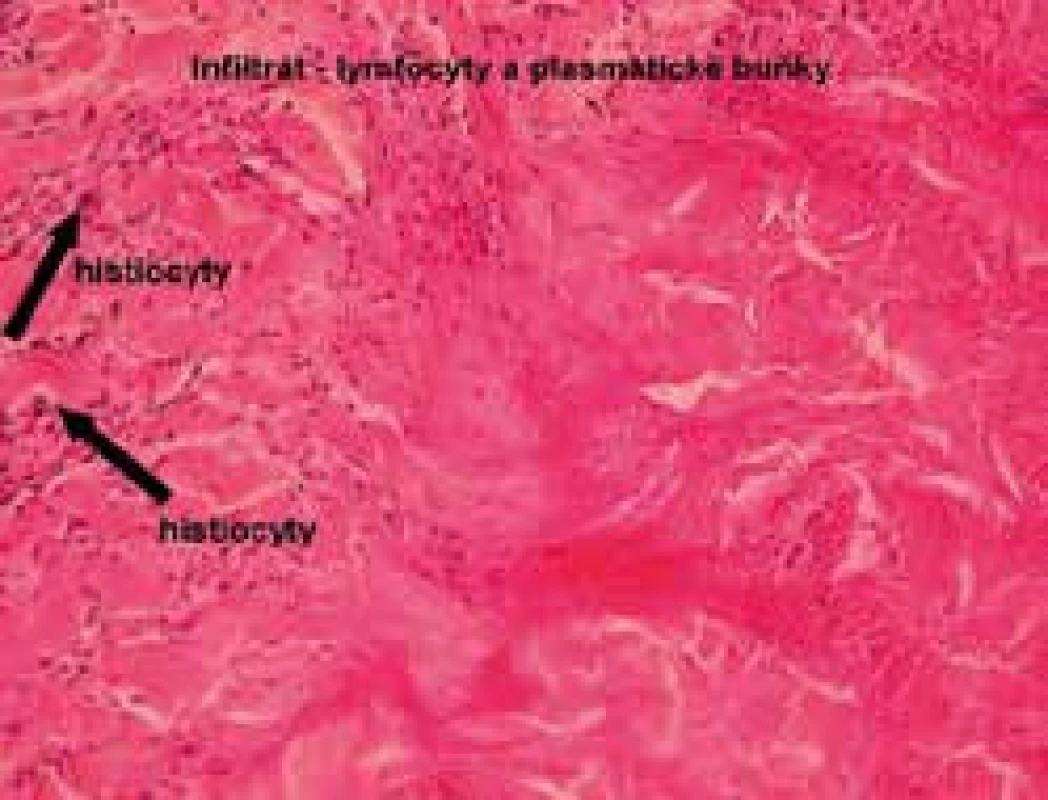 Histologie necrobiosis lipoidica, infiltrát z lymfocytů, přítomnost histiocytů (barvení hematoxylinem a eozinem)