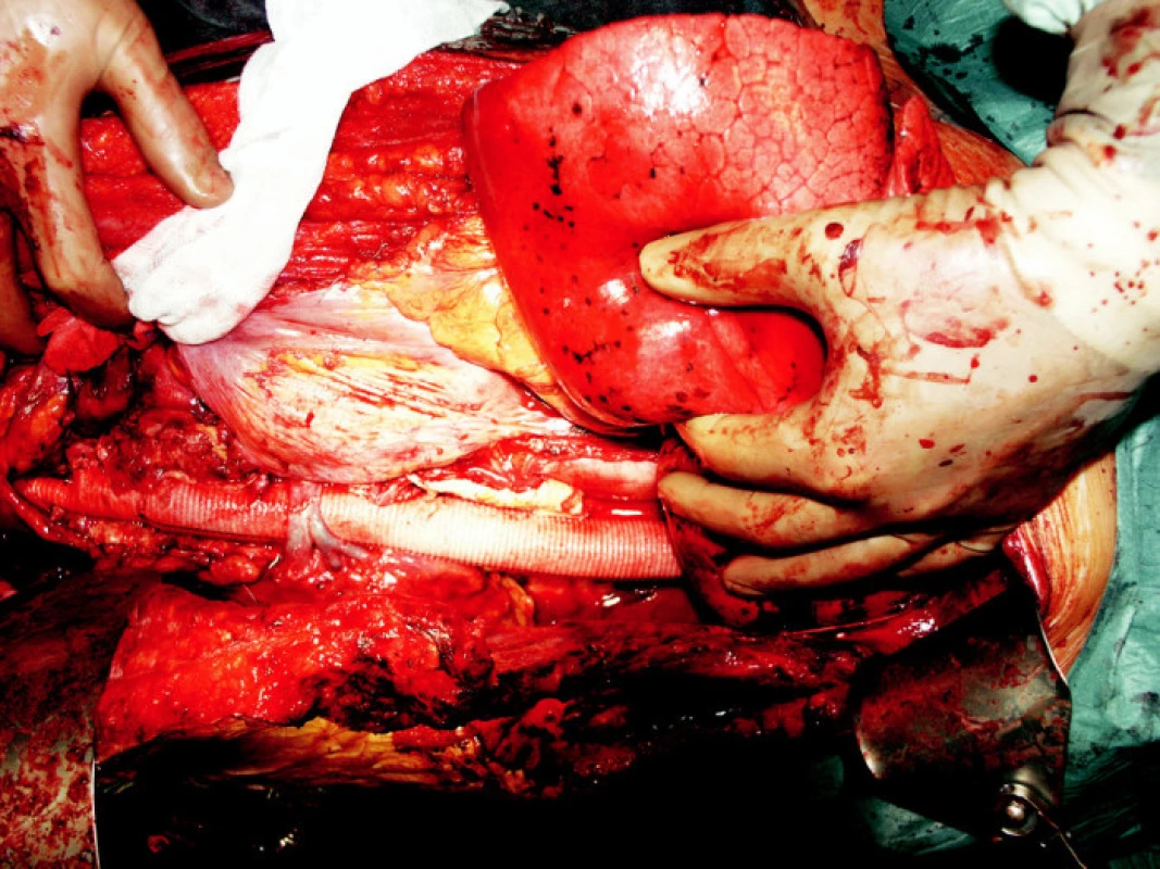 Pohled do operačního pole – náhrada hrudní a břišní aorty cévní protézou, viditelná sutura levostranné renální žíly, která prochází přes protézu
Fig. 1. A view of the operating field – replacement of the thoracic and abdominal aorta for a vascular prosthesis, a suture of the left renal vein, exiting over the prosthesis, is detectable
