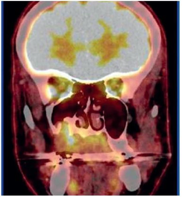 Koronární PET CT řez