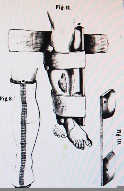 Dlahovací technika dle Pirogova (Klinická chirurgie, 1854)