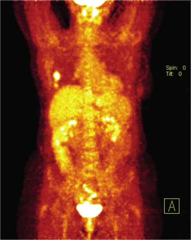 PET/CT vyšetření v říjnu 2012
Fig. 5: PET/CT scan in October 2012