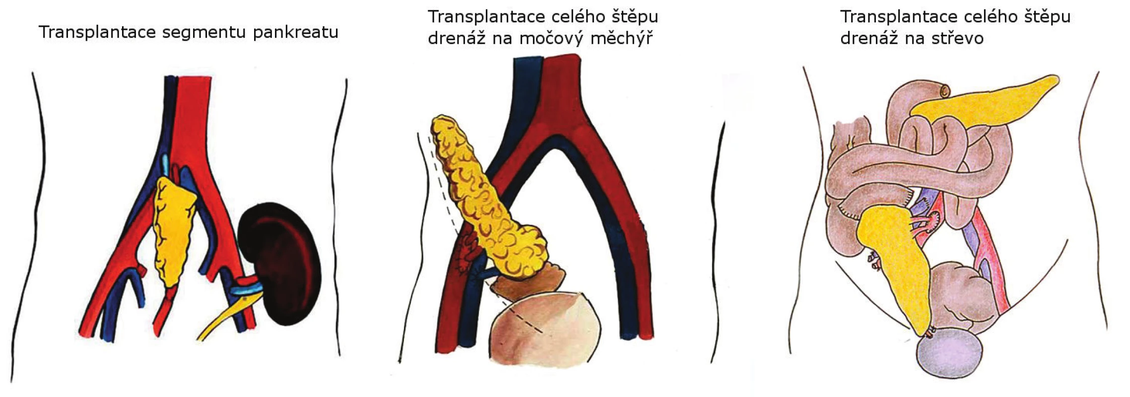 Techniky transplantace pankreatu používané v IKEM
Fig. 1. Pancreas transplantation techniques used in IKEM