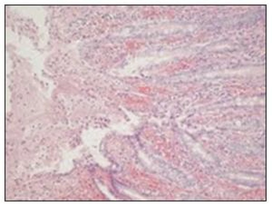 Detailný pohľad na sliznicu hrubého čreva s obrazom ischemickej kolitídy
Fig. 6. A detail view of the large intestinal muscosa showing signs of ischemic colitis
