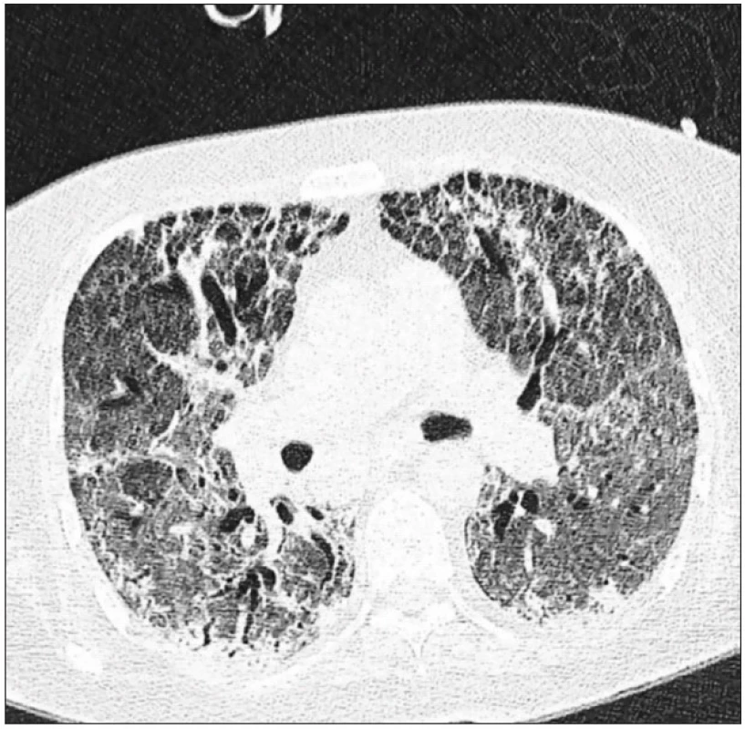 CT scan plic stejné pacientky 35. den hospitalizace 
Výrazně difuzně snížená transparence plicního parenchymu, vakovité bronchiektázie v obou plicních křídlech. Obraz odpovídá proliferativní fázi ARDS.