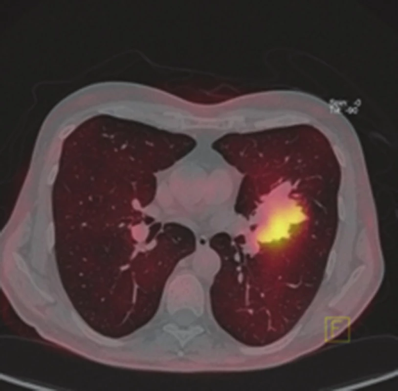 PET/CT hybridní obraz metabolicky aktivní metastázy hilu levé plíce (axiální řez)
Fig. 4: PET/CT hybrid scan of a metabolic active pulmonary metastasis (hilum of the left lung, axial view)