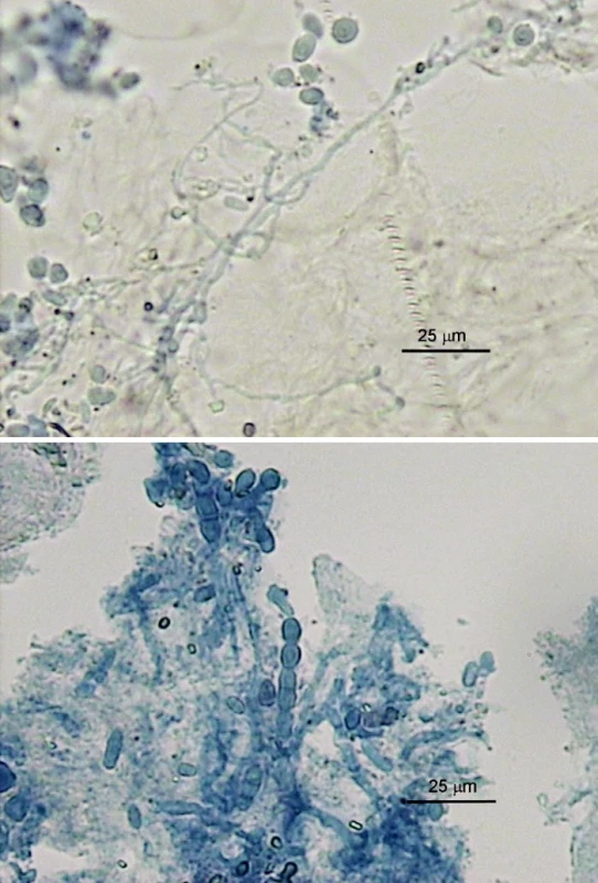 a, b. Mikroskopické nálezy v nechtoch pacientov (preparáty v KOH s Parker black ink); a) tenšia rozvetvená hýfa a oválne artrokonídiá, b) širšie polámané hýfy, artrokonídiá jednotlivo a v retiazkach (foto A.V.)
Fig. 1 a, b. Microscopy nail findings (potassim hydroxide and Parker black ink mounts); a) thin-walled hyphal branches and oval arthroconidia, b) thicker-walled hyphal fragments, single arthroconidia and arthroconidial chains (photo A.V.)