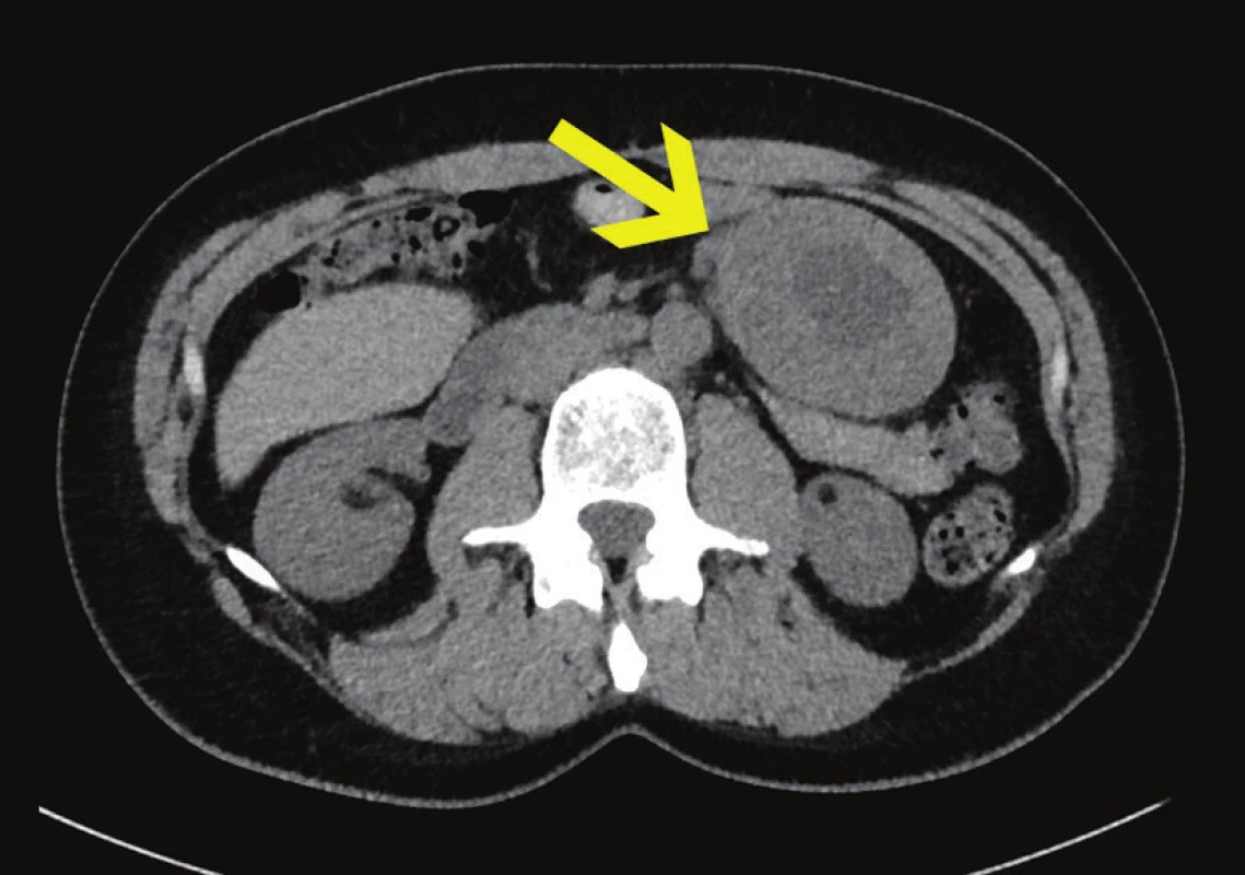 CT s tumorem v levém mezogastriu, axiální řez
Fig. 3: CT scan with tumour in the left mesogastrium, axial section