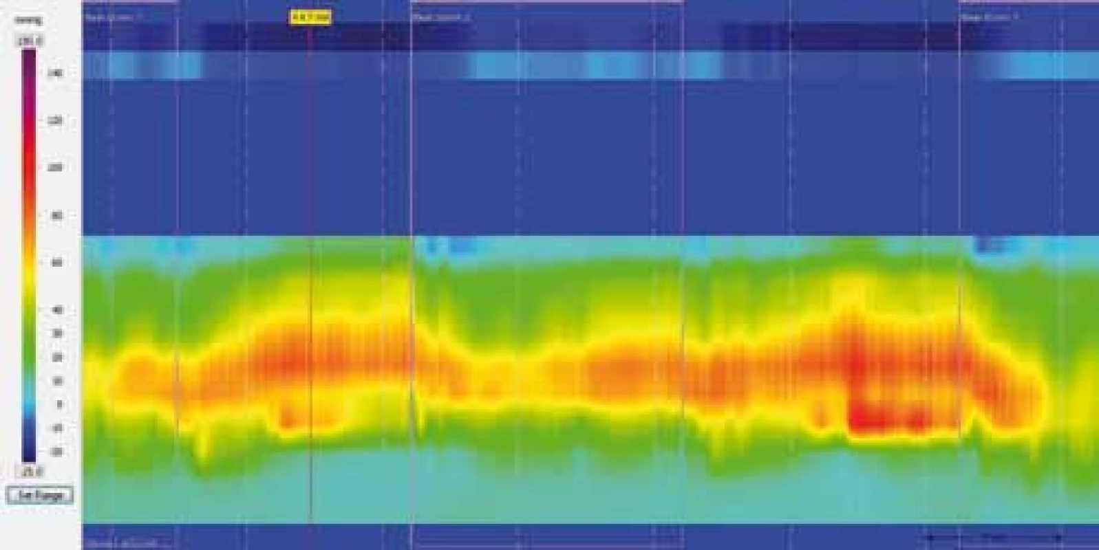 Barevná škála k zobrazení analyzovaných intraluminálních tlaků při HRAM.
Fig. 1. Color scale for depict of intraluminal pressure in HRAM.