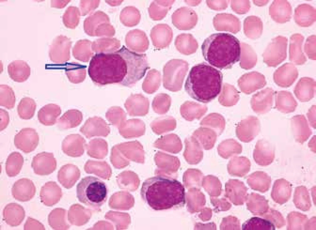 MCL, varianta podobná lymfomu z marginální zóny (středně velké lymfocyty s bohatší nepravidelnou bazofilní cytoplazmou, méně kondenzovaným jaderným chromatinem a místy naznačenými nukleoly, excentricita jádra jako plazmocytoidní rys – označena šipkou)