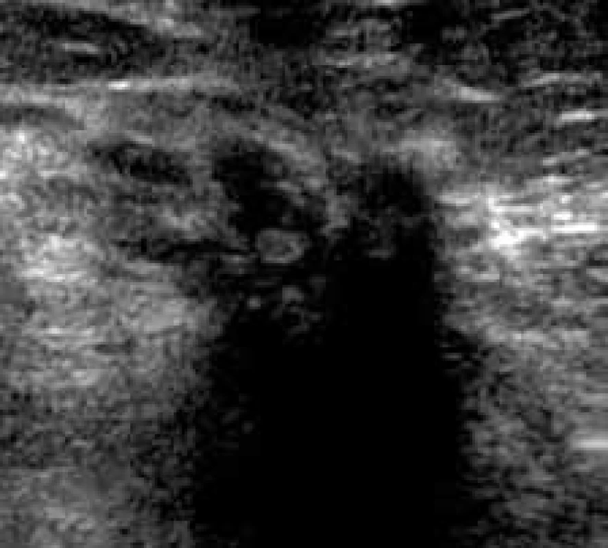 Nepravidelná nehomogenní area s mohutným akustickým stínem. Porušení podkoží, zesílení Coopperových ligament – jizva.