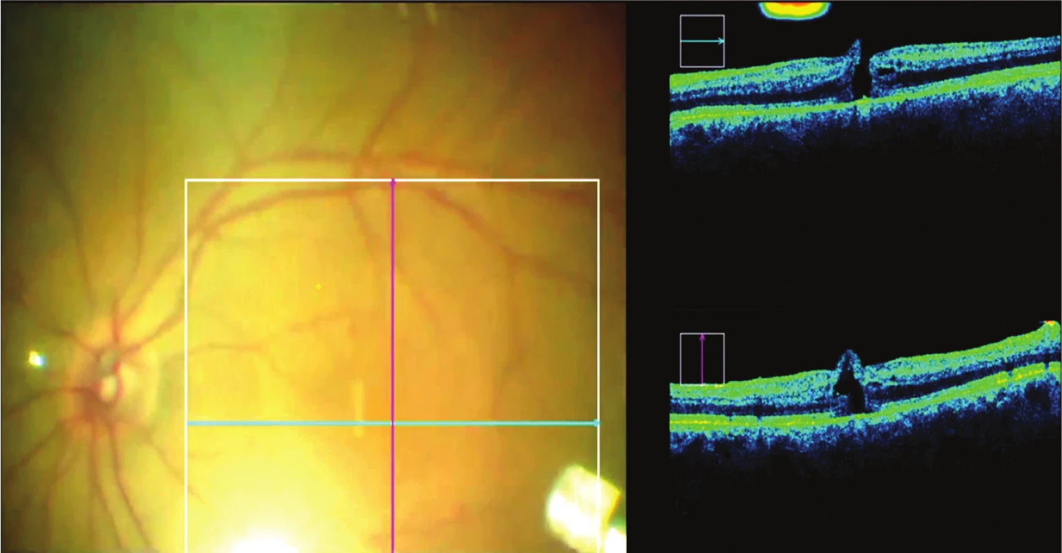 Intraoperační OCT umožňuje kontrolu makuly i při výměně za vzduchovou tamponádu, která výrazně ruší pohled na oční pozadí