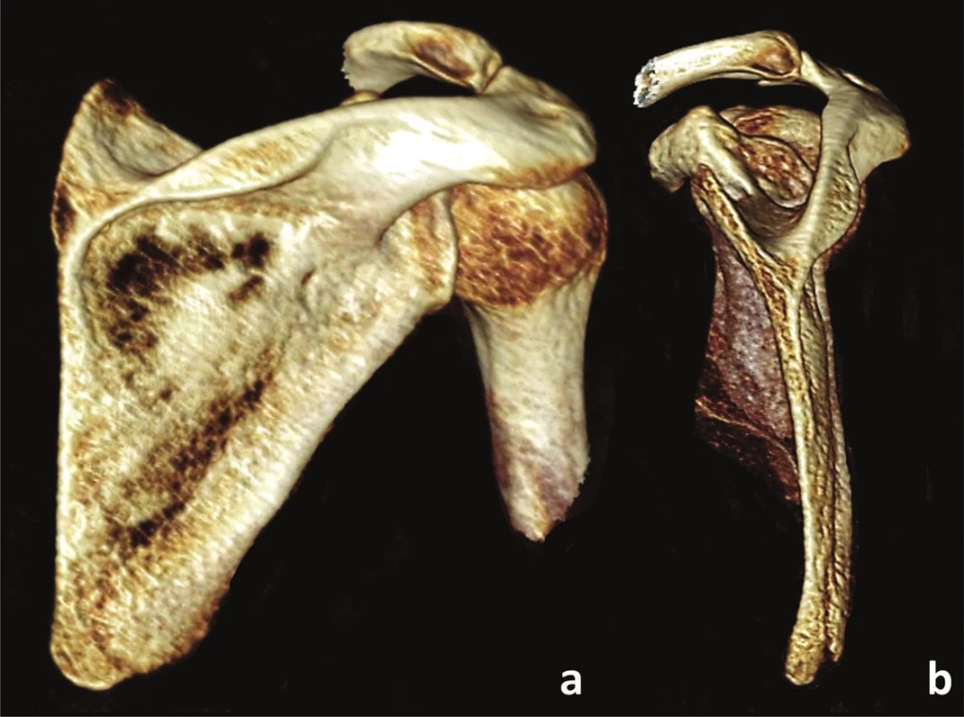 Zlomenina apexu dolního úhlu s ventrální angulací
a – dorzální pohled, b – mediální pohled.
Fig. 3: Fracture of apex of the inferior angle with anterior angulation
a – posterior view, b – medial view.