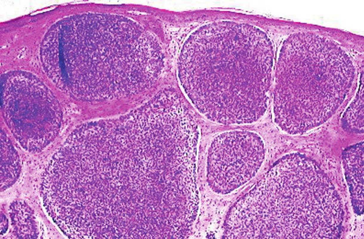 Nodulárny BCC – ostro ohraničené noduly bazaloidných nádorových buniek v derme (H&amp;E, 20x)