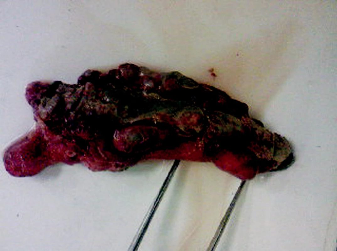 Gangrenózny apendix s divertikulózou, divertikulitídou a perforáciou na apexe apendixu vermiformis
Pic. 2. Gangrenous appendix with diverticulosis, diverticulitis and perforation of the appendix vermiformis apex