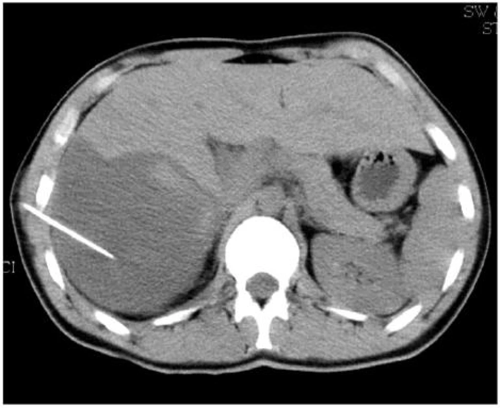 CT snímek jater: Perkutánní punkce nitrojaterního hematomu. jehla zavedena pod CT kontrolou