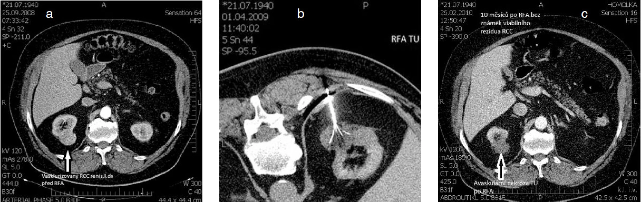 Příklad radiofrekvenční ablace karcinomu ledviny, kdy pro přidružená komplikující interní onemocnění by konveční chirurgické léčba představovala pro nemocného neúměrně vysokou zátěž a riziko a – nález vaskularizovaného karcinomu vycházejícího z dorzální části pravé ledviny při CT vyšetření, b – miniinvazivně vedená léčba pomocí perkutánní RFA navigovanou pod CT kontrolou, c – výsledný nález avaskulární nekrózy tumoru, který se nesytí po aplikací RTG kontrastní látky; dobrý výsledek léčby bez známek viabilního reziduálního karcinomu pravé ledviny s odstupem 10 měsíců po RFA