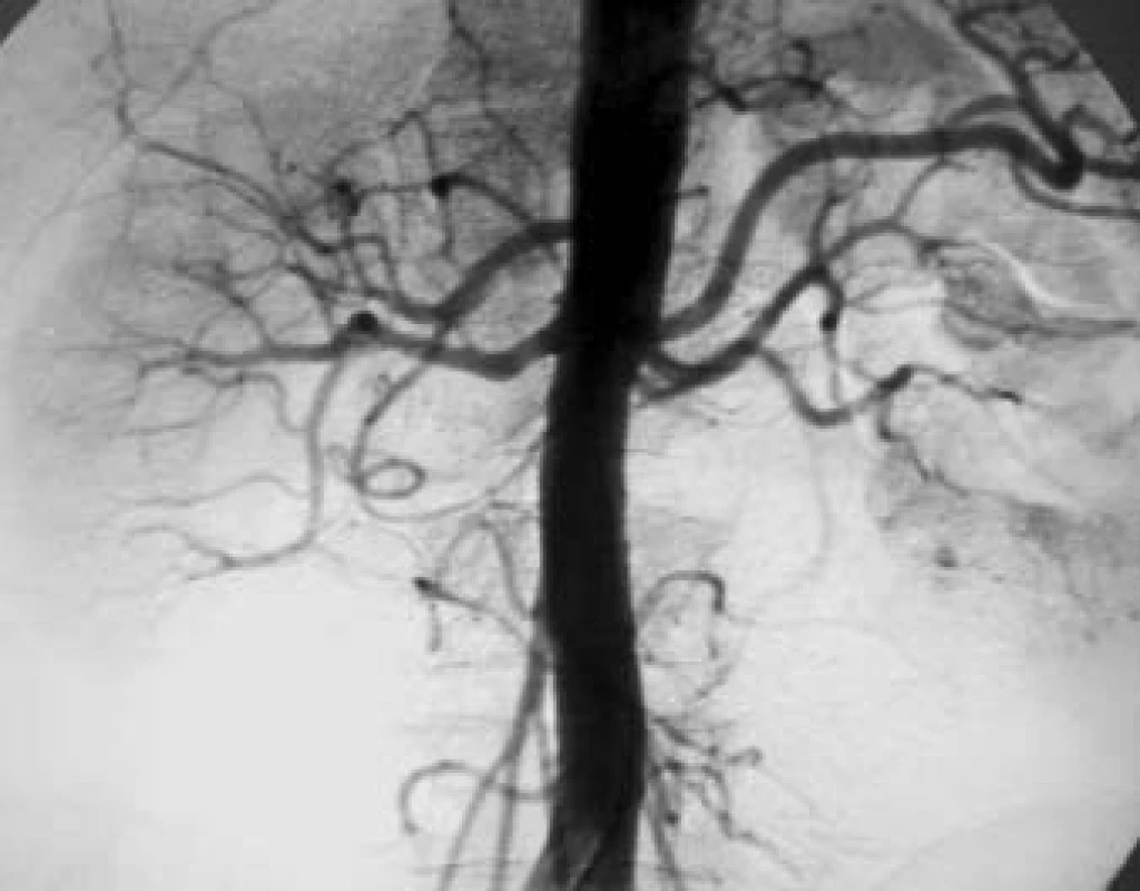 Přehledná angiografie abdominální aorty - dvě renální tepny pro levou ledvinu.