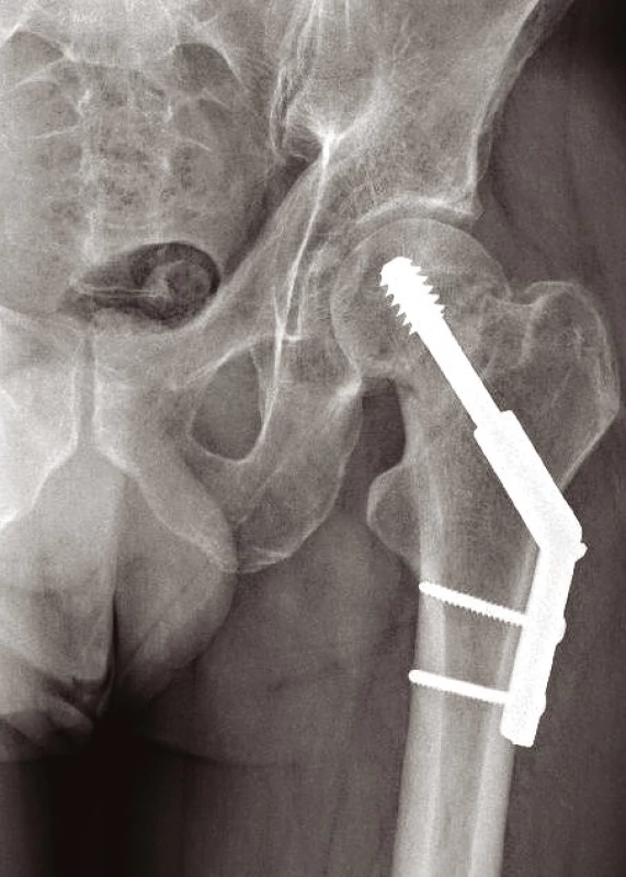 Zlomenina krčku femuru řešena OS dvouděrovou dlahou DHS