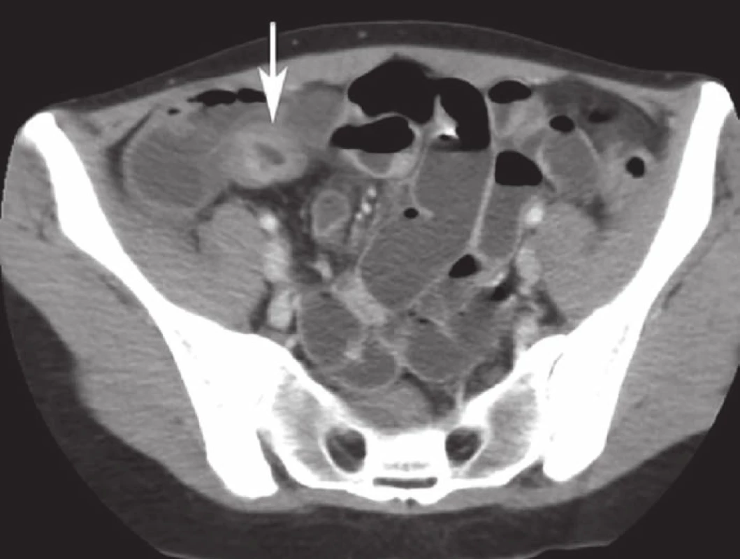 CT-enteroklýza s vyznačeným nálezom infiltrátu terminálneho ilea.
Fig. 1. CT enteroclysis with marked infiltration of the terminal ileum.