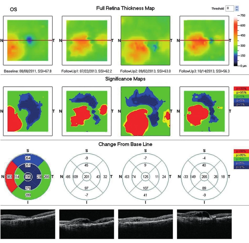 OCT snímok (porovnávací – po 2 rokoch liečby ranibizumabom). Progresia edému neuroretiny aj hrúbky sietnice – CHS: +265 μm