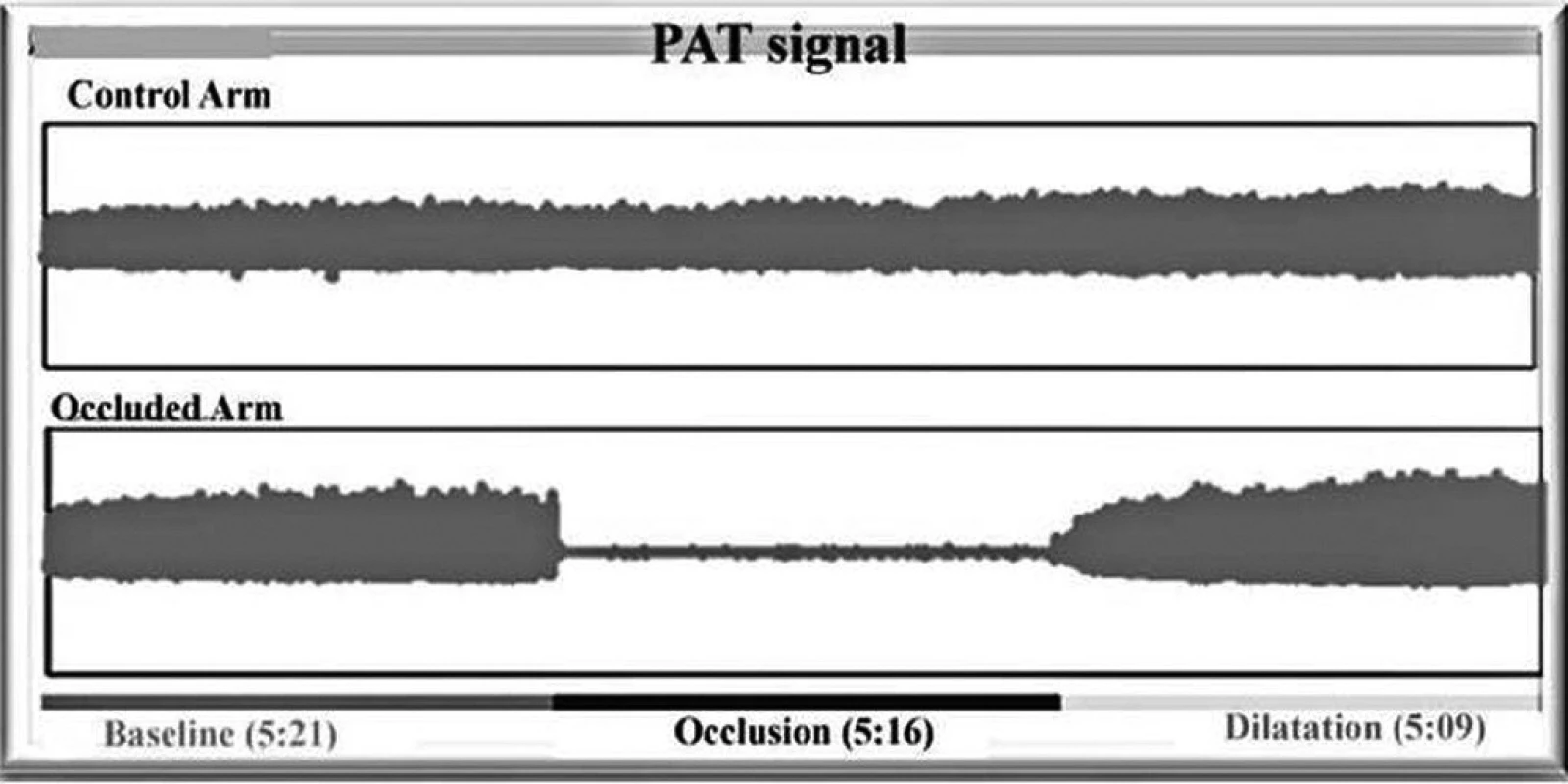 PAT signál v průběhu vyšetření. Na horní křivce záznam na kontrolní paži (control arm) a na dolní křivce záznam na vyšetřované paži (occuluded arm) s patrnou okluzí (occlusion) a následnou reaktivní hyperemií (RHI) – dilatation.