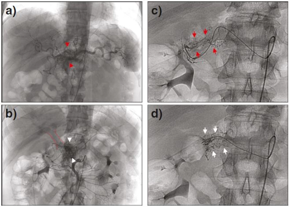 Celiacography and the selective angiography of the upper mesenteric, revealing feeding arteries from a common hepatic artery (a, &lt;i&gt;red arrowheads&lt;/i&gt;) and from the initial portion of the upper mesenteric artery (b, &lt;i&gt;white arrowheads&lt;/i&gt;), with early visualization of the portal vein in the same phase (&lt;i&gt;encircled in red&lt;/i&gt;). Additional vascular network branching from the watershed of the gastroduodenal artery (c, &lt;i&gt;red arrows&lt;/i&gt;) and hepatic artery proper (d, &lt;i&gt;white arrows&lt;/i&gt;) is also shown