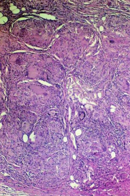 Podkožní sarkoidóza – granulomy nahrazující lalůček podkožní tukové tkánů s četnými obrovskými mnohojadernými Langhansovými buňkami a membranocystickou degenerací podkožní tukové tkánů.