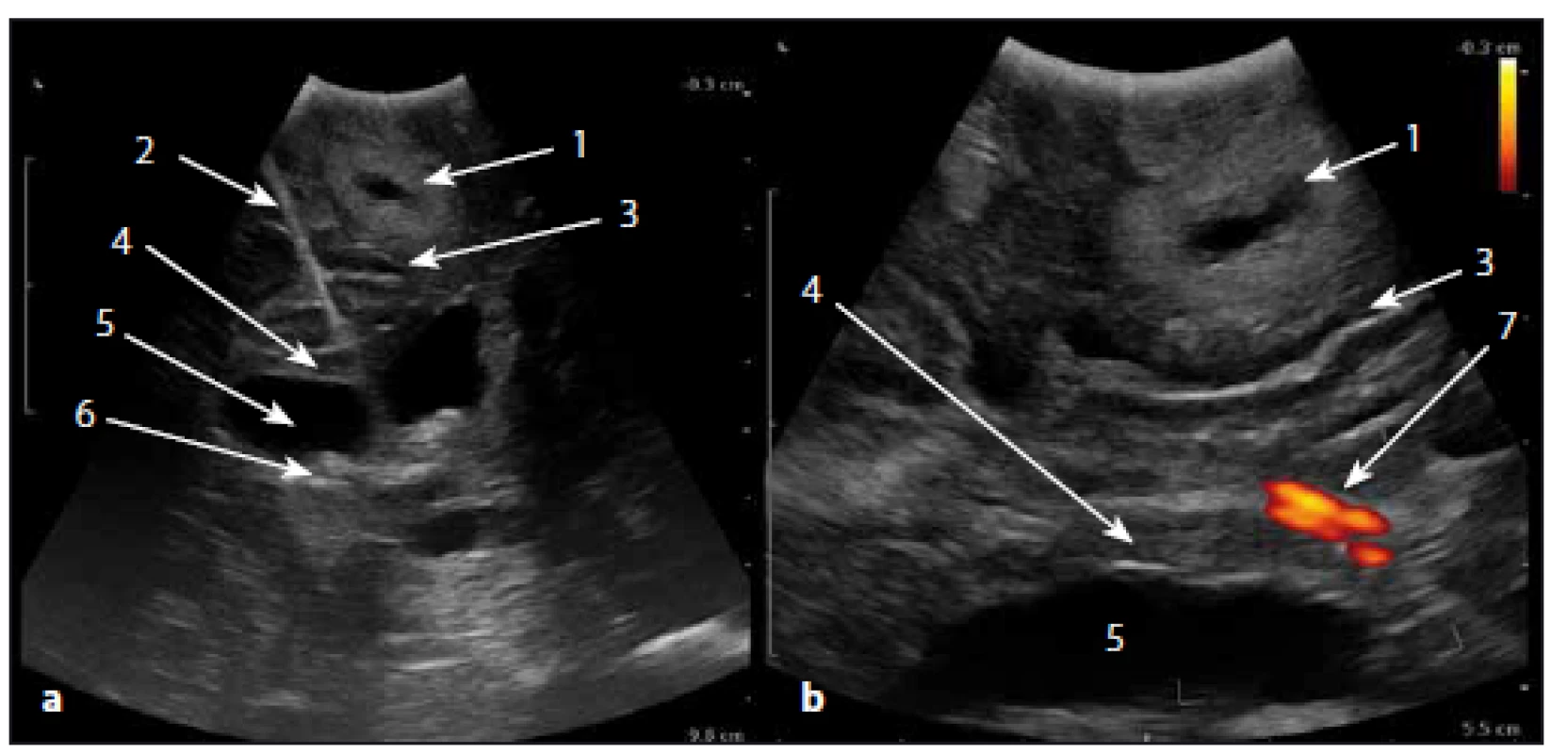 Intraoperativní sonografický obraz v B módu.
Fig. 1. Intraoperative ultrasound image in B-mode.