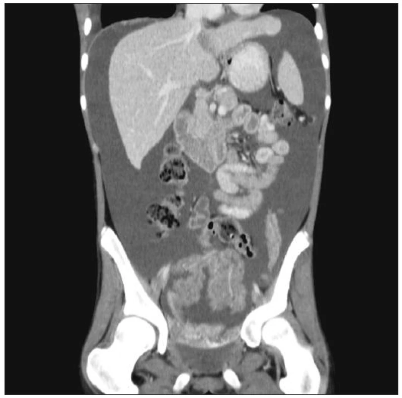 Masivní maligní ascites (snímek CT)
Fig. 2. Massive malignant ascites (CT view)