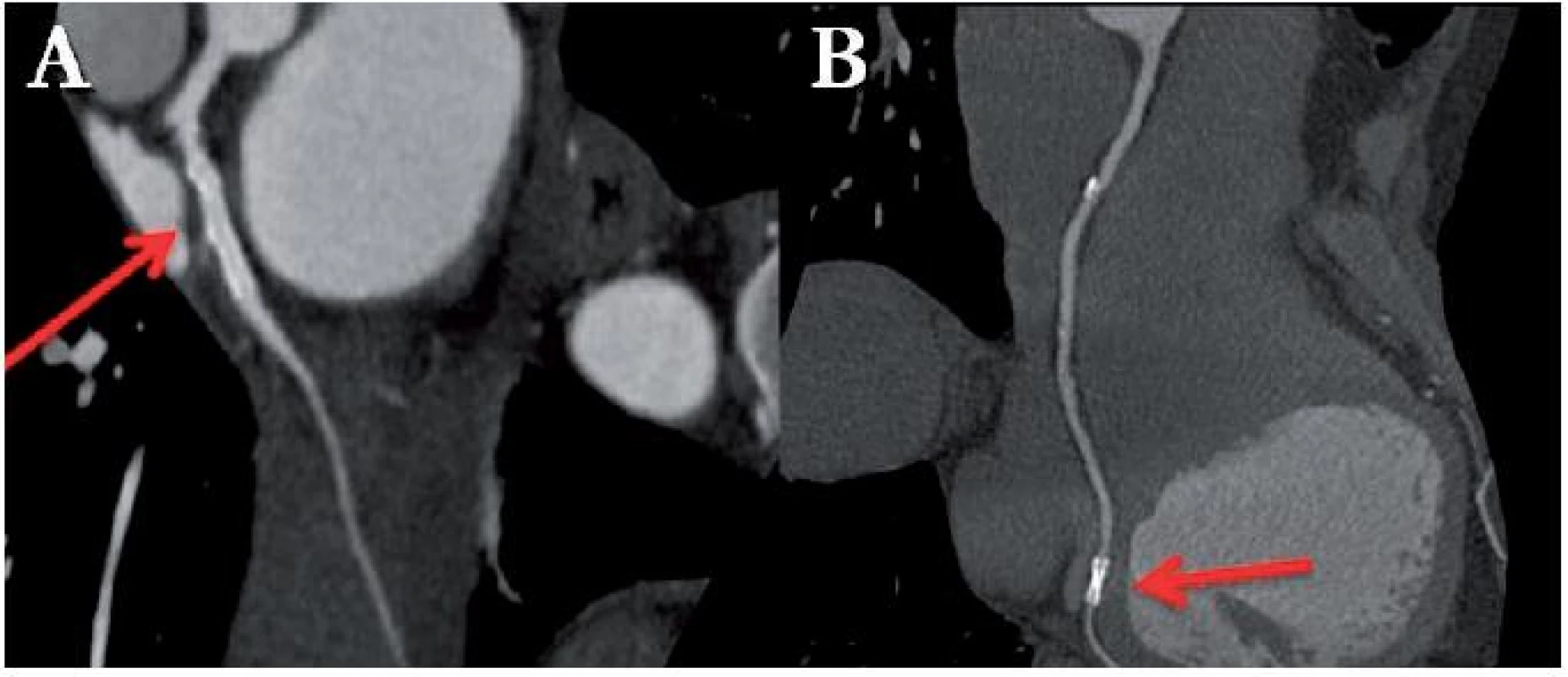 Stent s průměrem 4 mm implantován v proximálním úseku ramus circumflexus, bez známek restenózy (A). Stent s průměrem 2,5 mm implantován do ramus posterolateralis dexter, vyloučit restenózu vzhledem k malému průměru nelze (B).