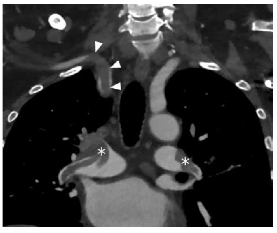 CT vyšetření, šipky – embolus v pravé a. subclavia,
hvězdičky – emboly v a. pulmonalis<br>
Fig. 1: CT scan, arrows – embolus in the right subclavian
artery, asterisks – emboli in pulmonary arteries