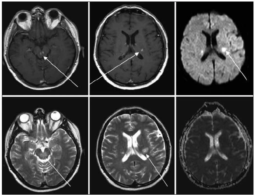 MR zobrazení mozku z 22. 1. 2009, tedy před léčbou. Na MR je viditelné postižení kmene, mozečku a bílé hmoty supratentoriálně, ložiska T1 hypo, T2 hyperintenzní, postkontrastně se sytící, restrikce difuse na DWI, bez korelace na ADC.
