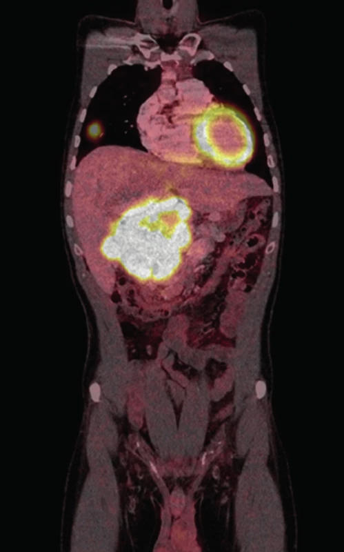 Objemný paragangliom retroperitonea s patrnou metastázou v pravé plíci (PET CT)
Fig. 6: Large retroperitoneal paraganglioma with lung metastasis (PET CT)