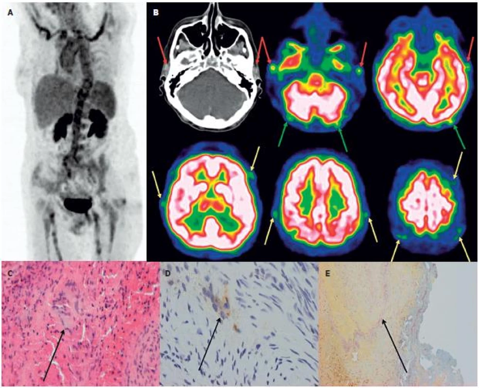 Kazuistika – žena 63 let. 3A Hybridní PET/CT vyšetření trupu PET MIP prokazuje u pacientky s „horečkou neznámého původu“ vysokou akumulaci FDG v aortě a velkých tepnách. 3B: Doplněné speciální snímání mozku detekovalo vysokou akumulaci FDG i ve spánkových tepnách (červené šipky), jejich frontálních a parietálních větvích (žluté šipky) i okcipitálních tepnách (zelené šipky). Histologické vyšetření z excize větve levostranné spánkové tepny prokázalo obrovskobuněčnou arteritidu.
(3C: HE, zv. 200x, označeny vícejaderné buňky, 3D: imunohistochemické vyšetření anti CD 68+, zv. 200x, označeny vícejaderné buňky, 3E: resorcin-fuchsin, zv. 100x, označen rozpad lamina elastica interna).
