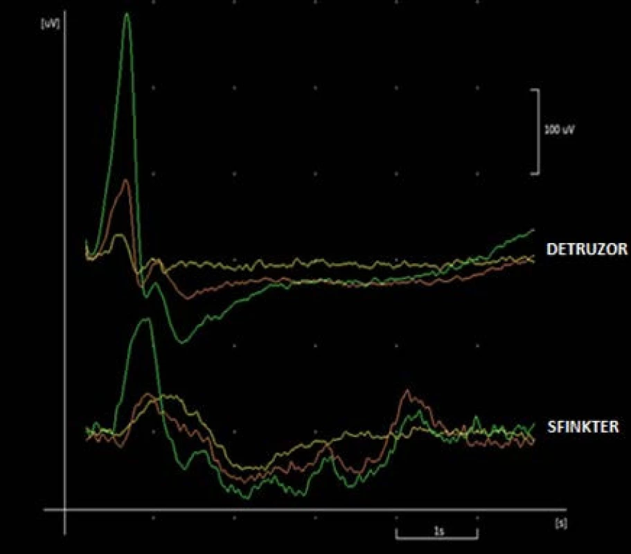 EMG odpověď detruzoru a sfinkteru, stimulace nad anastomózou
Fig. 5. Detrusor and sphincter EMG response – stimulation above the anastomosis