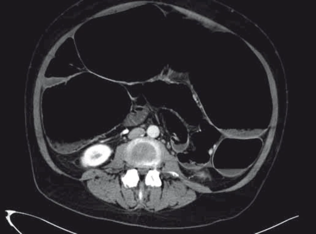 CT břicha při přijetí.
Fig. 2. Abdominal CT scan on admission.