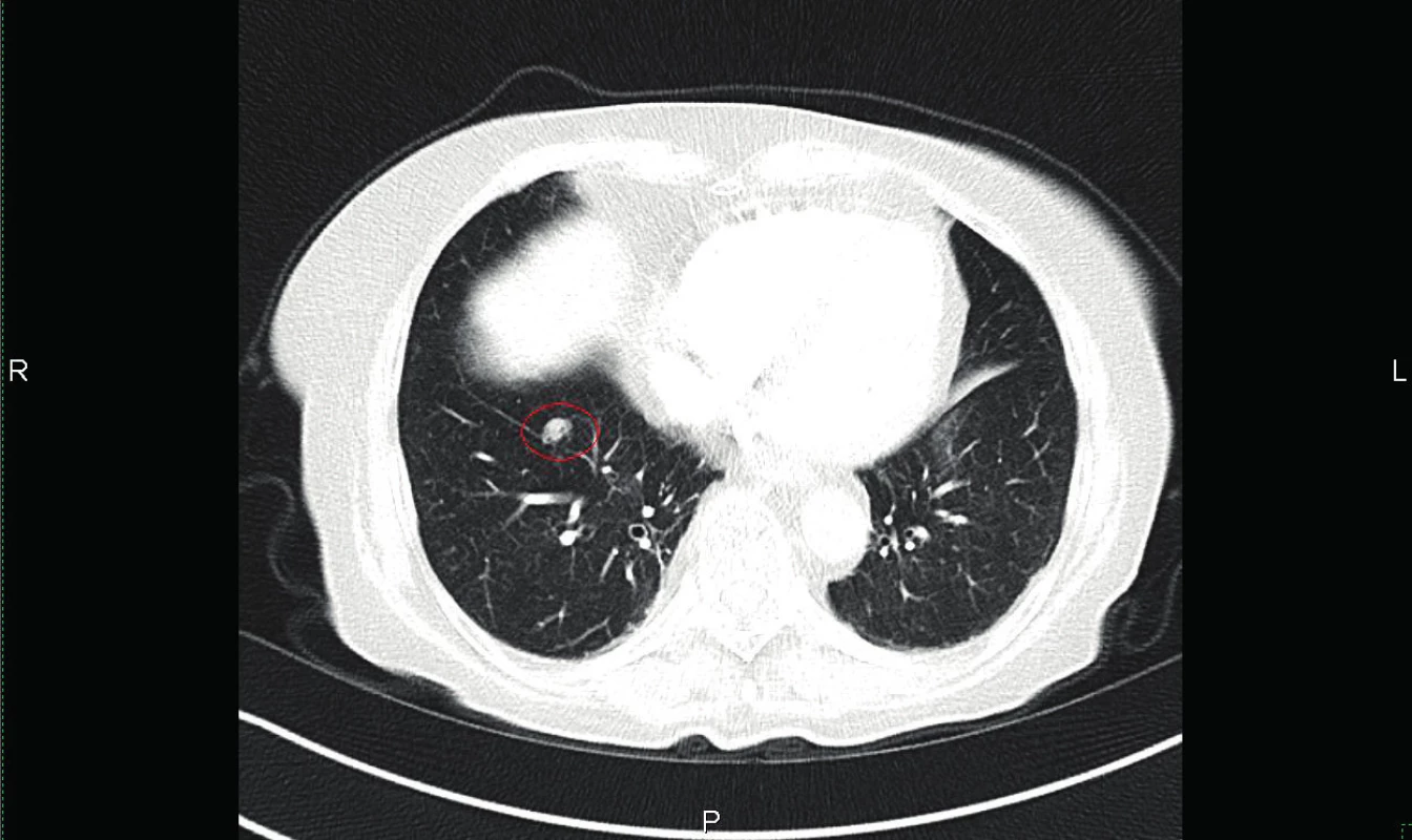 CT plic transverzální řez – známé ložisko