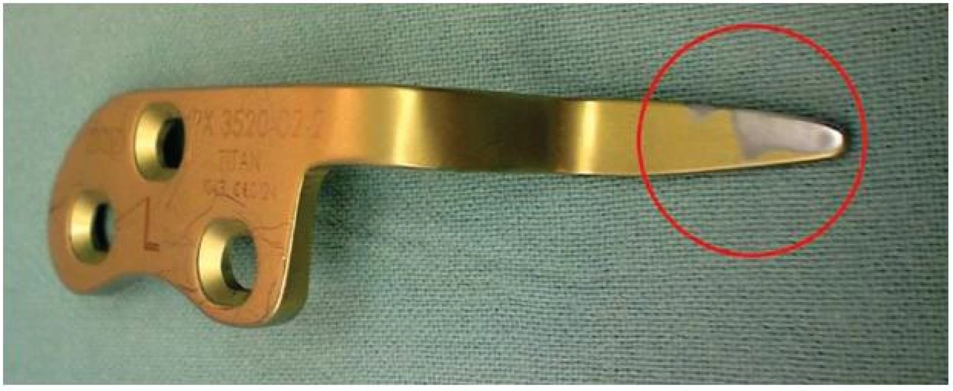 Dlaha po extrakci, je patrný otěr materiálu v místě kontaktu s akromiem
Fig. 4: Implant removal. Abrasion can be seen in the place of contact with the acromion