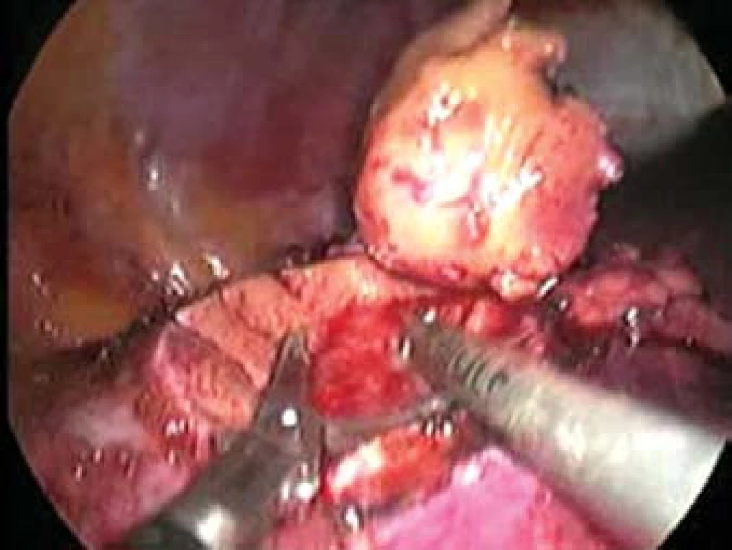 Resekce tumoru nůžkami, vpravo je patrná odsávačka. Obrázek je pořízen z videozáznamu.