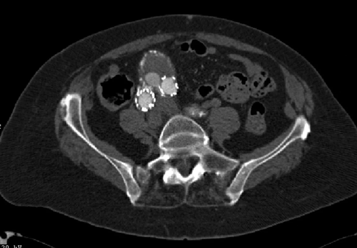 CTA obraz distálního endoleaku I. typu levé nožičky stentgraftu
Fig. 9: CTA image of the distal type I endoleak of a left leg of the stent graft