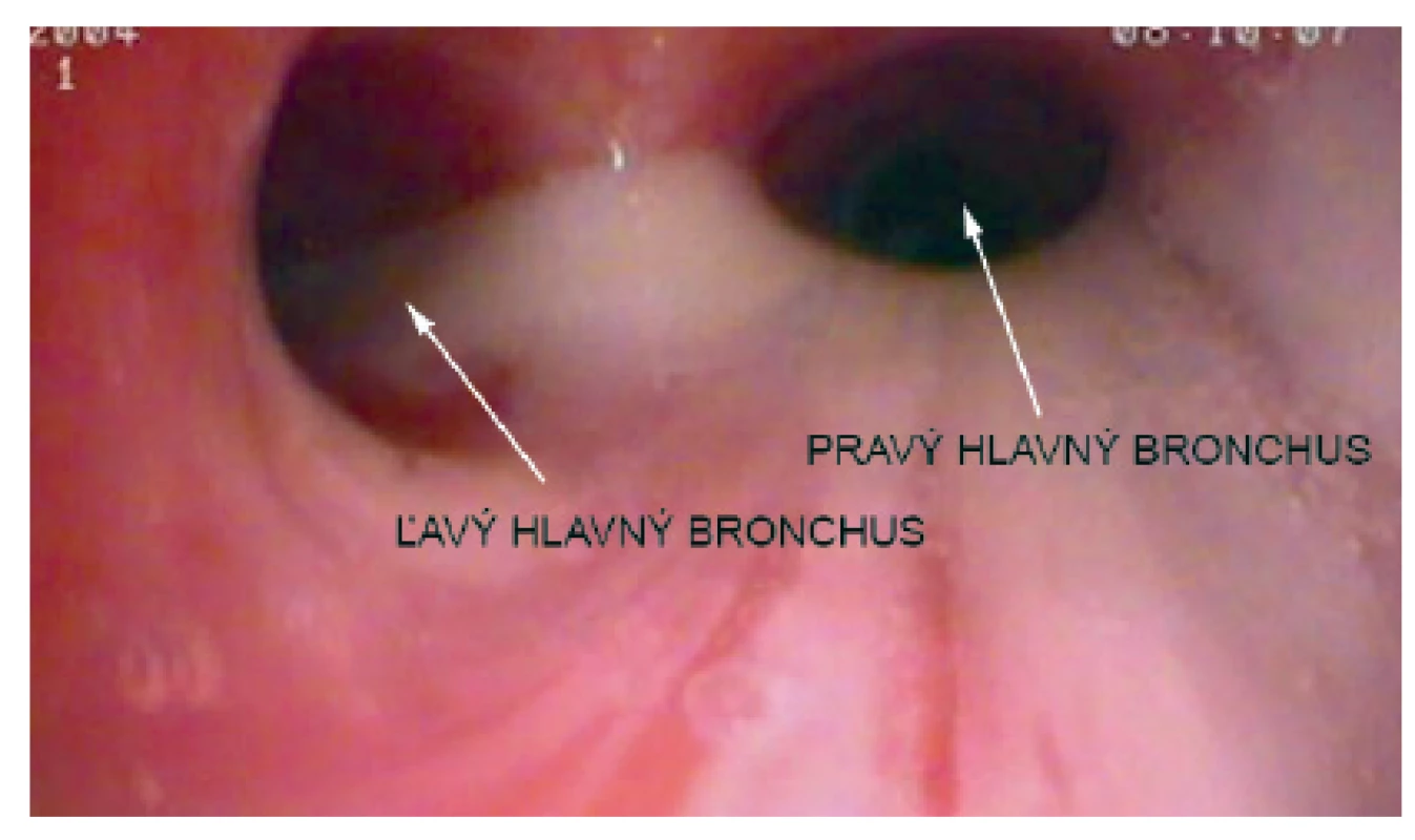 Bronchoskopický nález u našej pacientky – hustý belavý hlien vytekajúci z trachey.
Fig. 2. Bronchoscopic findings in our patient – thick white mucus flowing out of the trachea.