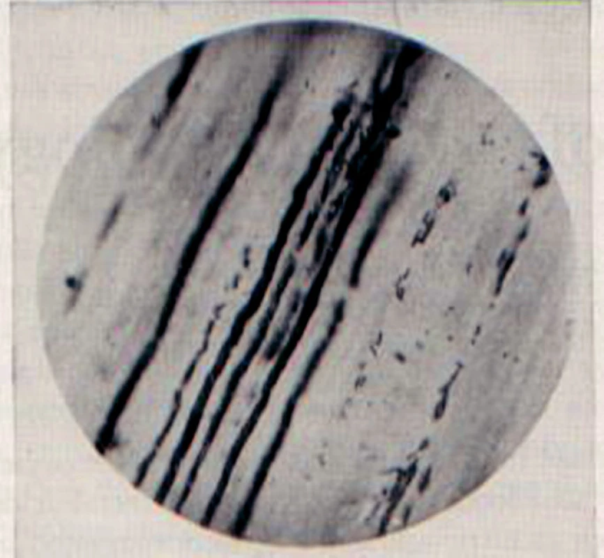 Podélný řez kazivým dentinem v jehož tubulech vidíme mikroorganismy. (Původní mikrofotografie z Millerovy knihy).